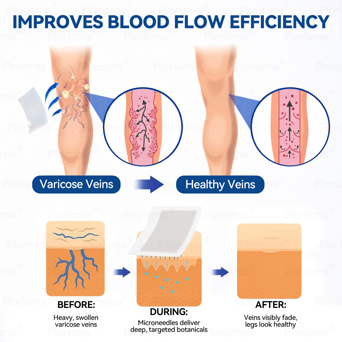 One Patch a Day. Visible Vein Relief in Just 7 Days 🍃 𝑭𝑳𝑶𝑹𝑰𝑺𝑴𝑨® 𝑫𝑰𝑶𝑺𝑴𝑰𝑵 & 𝑯𝑬𝑺𝑷𝑬𝑹𝑰𝑫𝑰𝑵 𝑪𝒍𝒊𝒏𝒊𝒄𝒂𝒍-𝑮𝒓𝒂𝒅𝒆 𝑭𝒐𝒓𝒎𝒖𝒍𝒂 𝑴𝒊𝒄𝒓𝒐𝒏𝒆𝒆𝒅𝒍𝒆 𝑷𝒂𝒕𝒄𝒉 𝗔𝗱𝘃𝗮𝗻𝗰𝗲𝗱 𝗛𝗲𝗿𝗯𝗮𝗹 𝗕𝗹𝗲𝗻𝗱 𝗧𝗮𝗿𝗴𝗲𝘁𝘀 𝗦𝗽𝗶𝗱𝗲𝗿 𝗩𝗲𝗶𝗻𝘀 & 𝗥𝗲𝗹𝗶𝗲𝘃𝗲𝘀 𝗛𝗲𝗮𝘃𝘆, 𝗧𝗶𝗿𝗲𝗱 𝗟𝗲𝗴𝘀 🎊