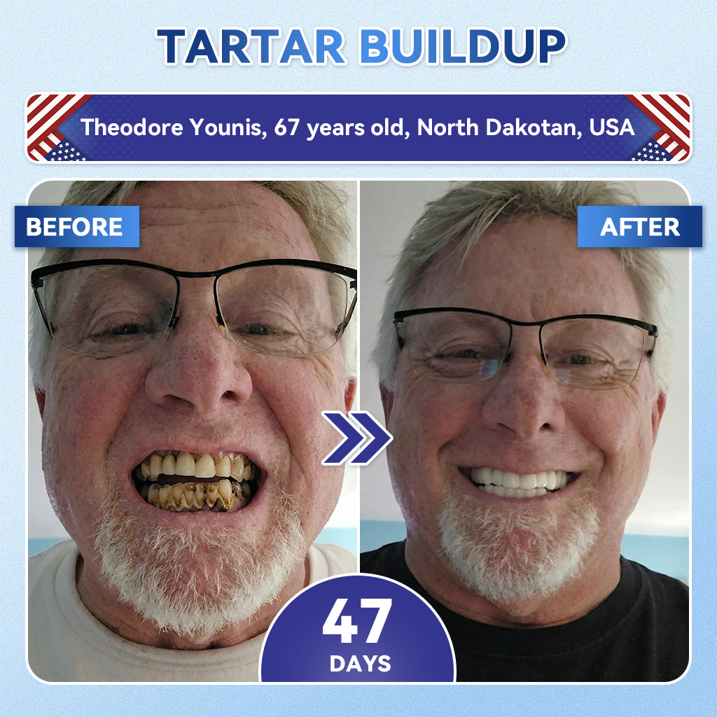 Glimmerly® 🦷 Tideglusib Fast‑Dissolving Tooth & Gum Repair Oral Strips 💭 (Supports tooth repair and helps relieve gum discomfort and other common oral concerns) 🛡️