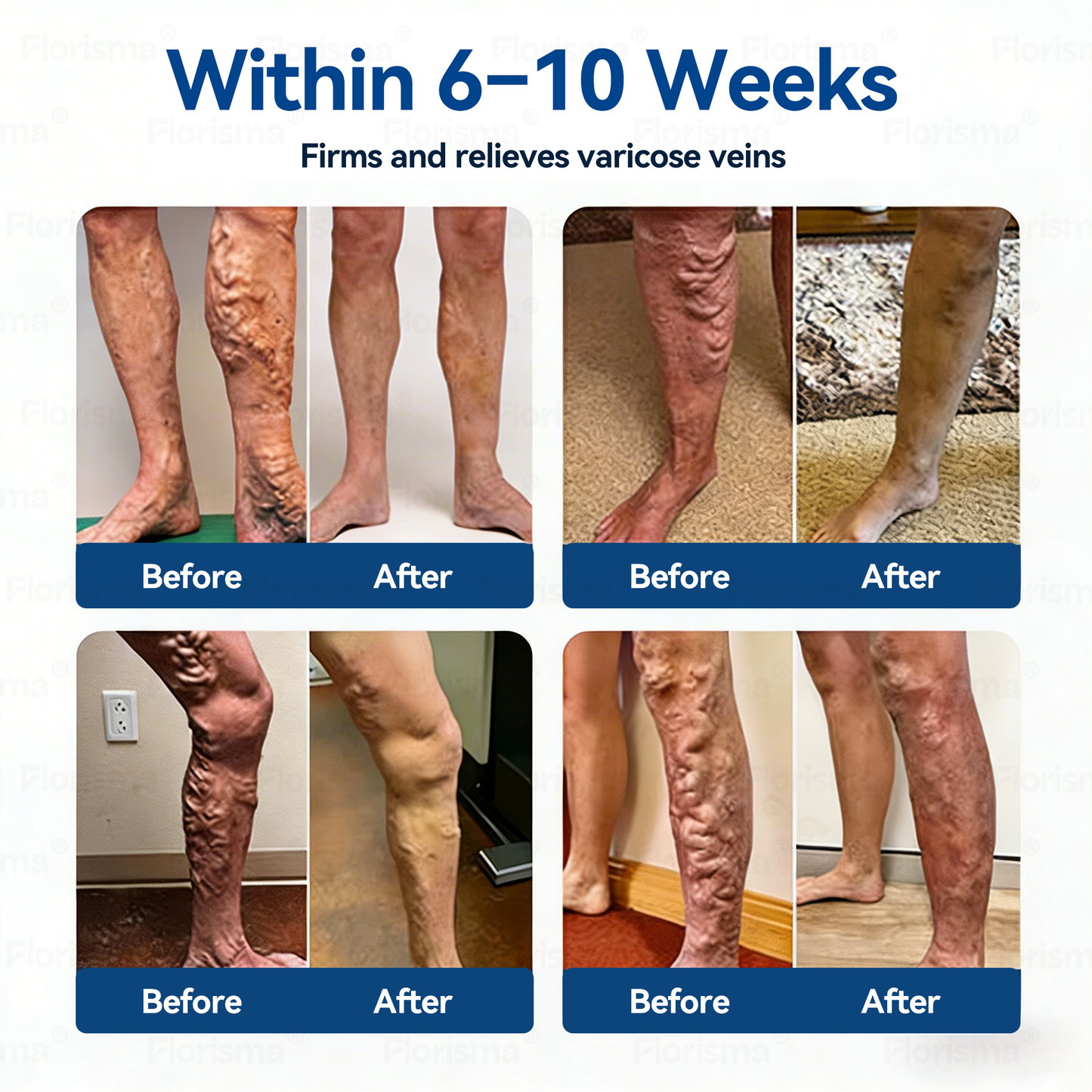 One Patch a Day. Visible Vein Relief in Just 7 Days 🍃 𝑭𝑳𝑶𝑹𝑰𝑺𝑴𝑨® 𝑫𝑰𝑶𝑺𝑴𝑰𝑵 & 𝑯𝑬𝑺𝑷𝑬𝑹𝑰𝑫𝑰𝑵 𝑪𝒍𝒊𝒏𝒊𝒄𝒂𝒍-𝑮𝒓𝒂𝒅𝒆 𝑭𝒐𝒓𝒎𝒖𝒍𝒂 𝑴𝒊𝒄𝒓𝒐𝒏𝒆𝒆𝒅𝒍𝒆 𝑷𝒂𝒕𝒄𝒉 𝗔𝗱𝘃𝗮𝗻𝗰𝗲𝗱 𝗛𝗲𝗿𝗯𝗮𝗹 𝗕𝗹𝗲𝗻𝗱 𝗧𝗮𝗿𝗴𝗲𝘁𝘀 𝗦𝗽𝗶𝗱𝗲𝗿 𝗩𝗲𝗶𝗻𝘀 & 𝗥𝗲𝗹𝗶𝗲𝘃𝗲𝘀 𝗛𝗲𝗮𝘃𝘆, 𝗧𝗶𝗿𝗲𝗱 𝗟𝗲𝗴𝘀 🎊