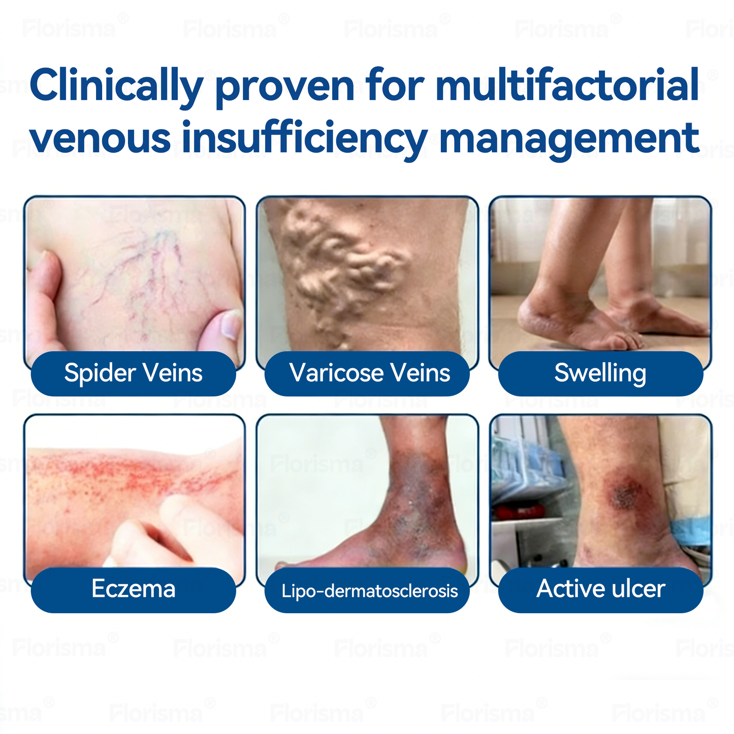 One Patch a Day. Visible Vein Relief in Just 7 Days 🍃 𝑭𝑳𝑶𝑹𝑰𝑺𝑴𝑨® 𝑫𝑰𝑶𝑺𝑴𝑰𝑵 & 𝑯𝑬𝑺𝑷𝑬𝑹𝑰𝑫𝑰𝑵 𝑪𝒍𝒊𝒏𝒊𝒄𝒂𝒍-𝑮𝒓𝒂𝒅𝒆 𝑭𝒐𝒓𝒎𝒖𝒍𝒂 𝑴𝒊𝒄𝒓𝒐𝒏𝒆𝒆𝒅𝒍𝒆 𝑷𝒂𝒕𝒄𝒉 𝗔𝗱𝘃𝗮𝗻𝗰𝗲𝗱 𝗛𝗲𝗿𝗯𝗮𝗹 𝗕𝗹𝗲𝗻𝗱 𝗧𝗮𝗿𝗴𝗲𝘁𝘀 𝗦𝗽𝗶𝗱𝗲𝗿 𝗩𝗲𝗶𝗻𝘀 & 𝗥𝗲𝗹𝗶𝗲𝘃𝗲𝘀 𝗛𝗲𝗮𝘃𝘆, 𝗧𝗶𝗿𝗲𝗱 𝗟𝗲𝗴𝘀 🎊