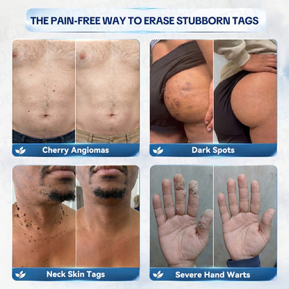 𝐏𝐢𝐜𝐝𝐨® 7-𝐃𝐚𝐲 𝐒𝐤𝐢𝐧 𝐓𝐚𝐠 & 𝐒𝐩𝐨𝐭 𝐄𝐫𝐚𝐬𝐞𝐫 𝐂𝐫𝐞𝐚𝐦 (Zero Pain, Zero 𝐒𝐜𝐚𝐫𝐬 Formula) 🪁