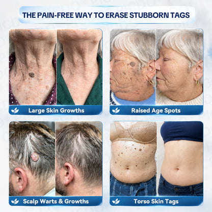 𝐏𝐢𝐜𝐝𝐨® 7-𝐃𝐚𝐲 𝐒𝐤𝐢𝐧 𝐓𝐚𝐠 & 𝐒𝐩𝐨𝐭 𝐄𝐫𝐚𝐬𝐞𝐫 𝐂𝐫𝐞𝐚𝐦 (Zero Pain, Zero 𝐒𝐜𝐚𝐫𝐬 Formula) 🪁