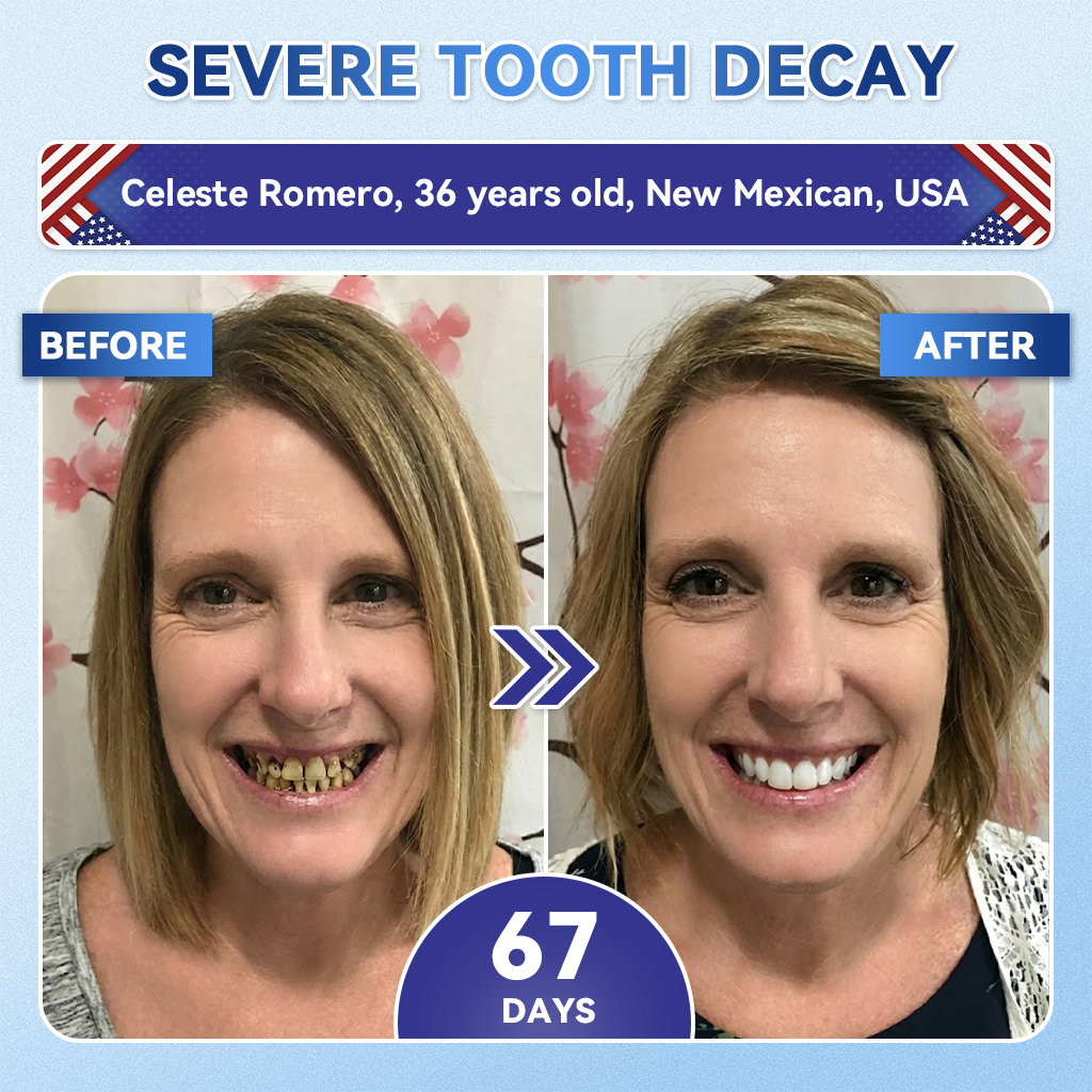 Glimmerly® 🦷 Tideglusib Fast‑Dissolving Tooth & Gum Repair Oral Strips 💭 (Supports tooth repair and helps relieve gum discomfort and other common oral concerns) 🛡️