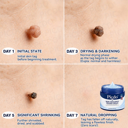 𝐏𝐢𝐜𝐝𝐨® 7-𝐃𝐚𝐲 𝐒𝐤𝐢𝐧 𝐓𝐚𝐠 & 𝐒𝐩𝐨𝐭 𝐄𝐫𝐚𝐬𝐞𝐫 𝐂𝐫𝐞𝐚𝐦 (Zero Pain, Zero 𝐒𝐜𝐚𝐫𝐬 Formula) 🪁